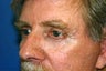 Blepharoplasty