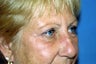 Blepharoplasty