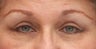 Blepharoplasty and endoscopic browlift