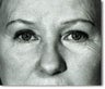 Eyelid Surgery