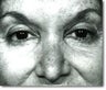 Eyelid Surgery