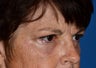 Blepharoplasty