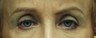 Blepharoplasty