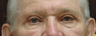 Upper Eyelid Lift