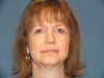 Endoscopic browlift, Upper and Lower Eyelid surgery