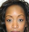 Blepharoplasty