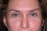 Eyelid Surgery
