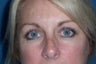 Eyelid Surgery