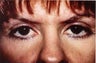 Eyelid Surgery