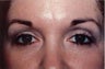 Eyelid Surgery
