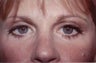 Eyelid Surgery