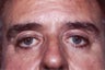 Eyelid Surgery For Men