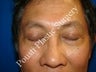 Eye Surgery (Blepharoplasty)