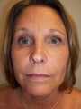 Upper & Lower Eyelid Lift and Brow Lift combination