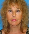 Facelift, Lower Blepharoplasty, Endoscopic Brow Lift