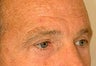 Eyelid Surgery and Brow Lift
