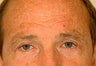 Before and After Blepharoplasty and Brow Lift