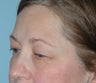 Upper Blepharoplasty (Eyelid Lift)
