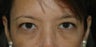 Upper Blepharoplasty