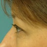 Upper Blepharoplasty