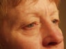 Eyelid surgery with CO2 laser resurfacing