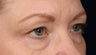 Eyelid surgery