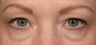 Eyelid surgery