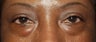 Eyelid surgery
