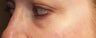 Eyelid surgery