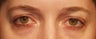 Eyelid surgery