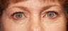 Eyelid surgery