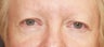 Eyelid surgery