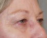 Eyelid surgery