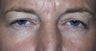 Upper Lid Blepharoplasty