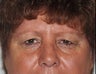Upper Lid Blepharoplasty and Ptosis Repair