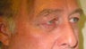Upper Lid Blepharoplasty