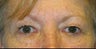 Upper and Lower Lid Blepharoplasty