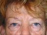 Upper and Lower Lid Blepharoplasty