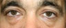 Eyelift