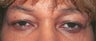 Eyelid Lift Surgery