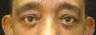 Upper Blepharoplasty