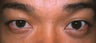 Asian Eyelid Surgery