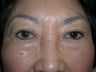 Blepharoplasty