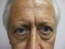 Blepharoplasty