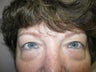 Blepharoplasty
