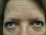 Blepharoplasty
