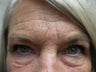 Blepharoplasty