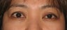 Eyelid retraction repair in thyroid disease by CO2 laser