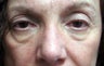 Upper and lower bleph and midface/cheek lift
