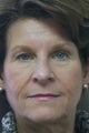 Upper eyelid lift